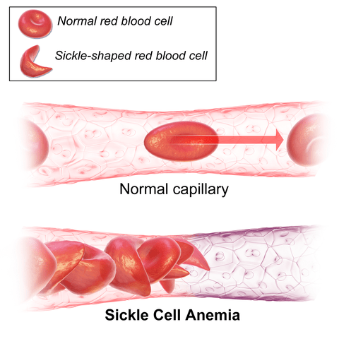 How To Prevent Anemia And Boost Your Iron Levels