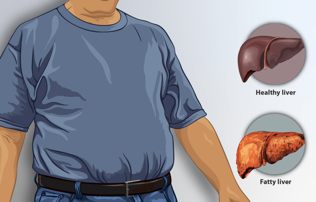 Do You Have A Fatty Liver? Here’s How To Get Rid Of It